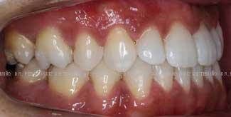 Ortodoncia-lingual-resultado-dcha