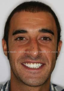 Ortodoncia lingual resultado extraoral