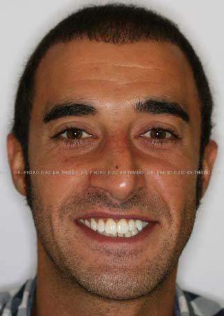 Ortodoncia lingual resultado extraoral