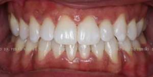 Ortodoncia-lingual-resultado-frente