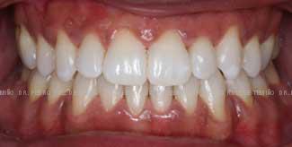 Ortodoncia-lingual-resultado-frente