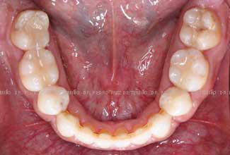 Ortodoncia-lingual-resultado-inf