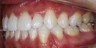 Ortodoncia-lingual-resultado-izda