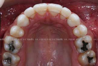 Ortodoncia-lingual-resultado-sup