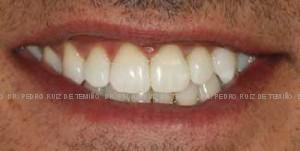 Ortodoncia lingual sonrisa despues