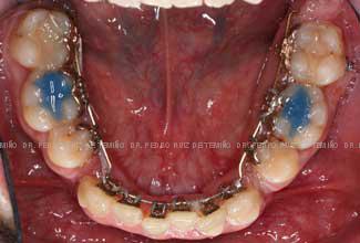 Ortodoncia-lingual-transcurso-inf