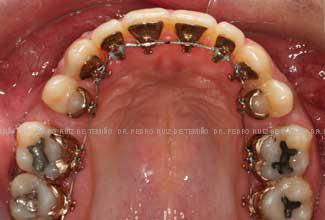 Ortodoncia-lingual-transcurso-sup