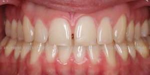 Invisalign diastema antes