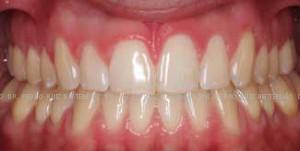 Invisalign diastema después