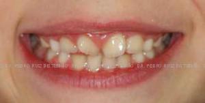 Primera fase temprana dientes torcidos antes