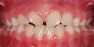 Primera fase temprana dientes torcidos antes
