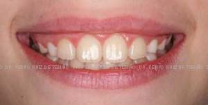 Primera fase temprana dientes torcidos después