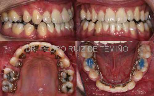 Alineamiento inicial - mayo