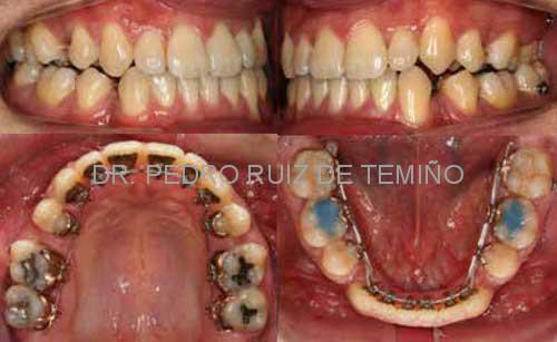 Fase de cierre