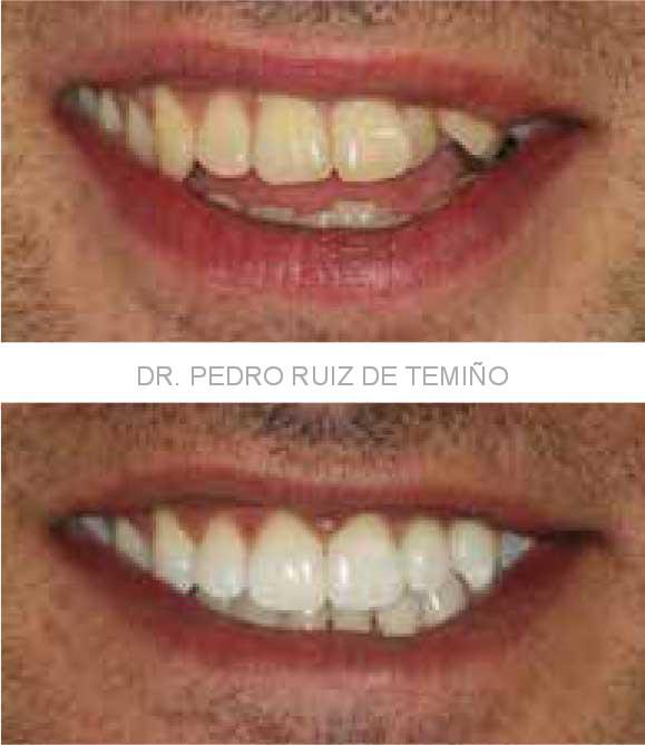 Sonrisa antes y después